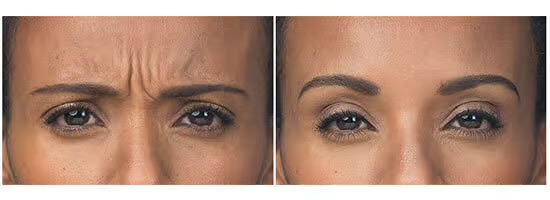 Glabella Lines Botox