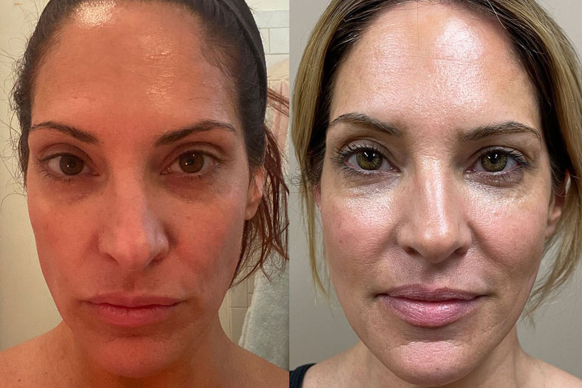 PDO thread lift treatment consultation and procedure