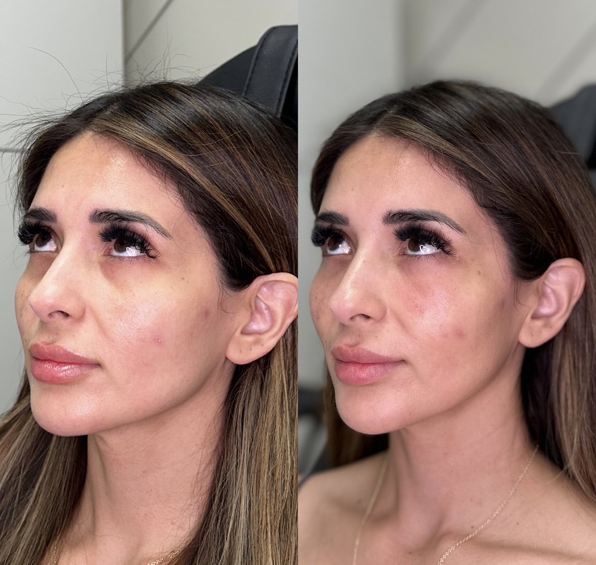 PRF Nasolabial Folds