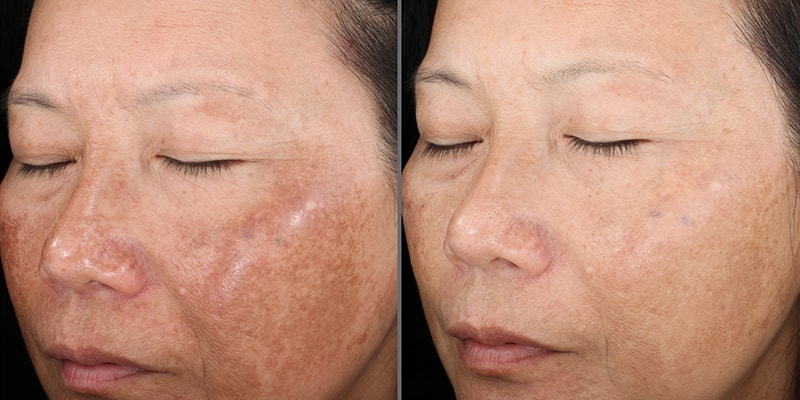 Rejuvenize Peel