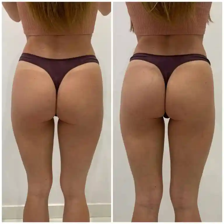 Non-Surgical Brazilian Butt Lift
