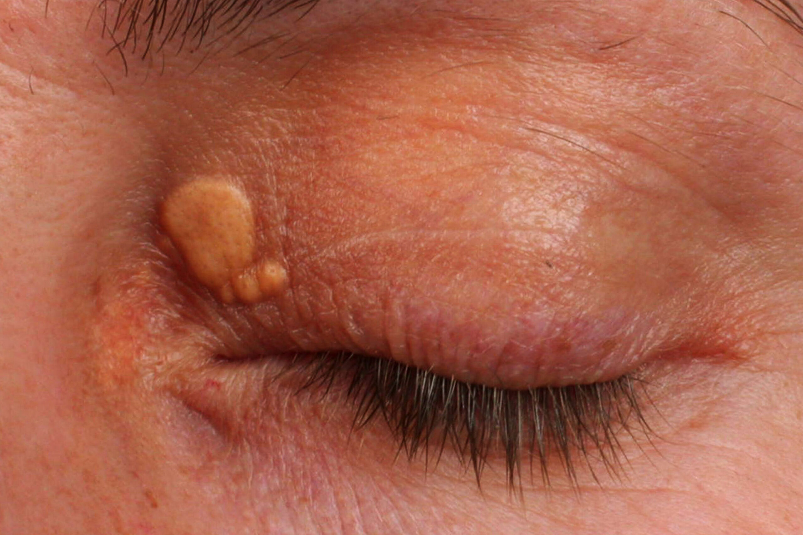 Cholesterol Deposits Treatment